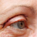 Eyelid Reconstructive Surgery